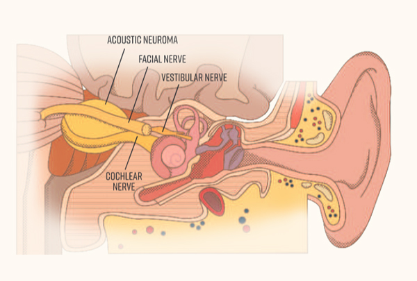 Pregnancy Acoustic Surgery