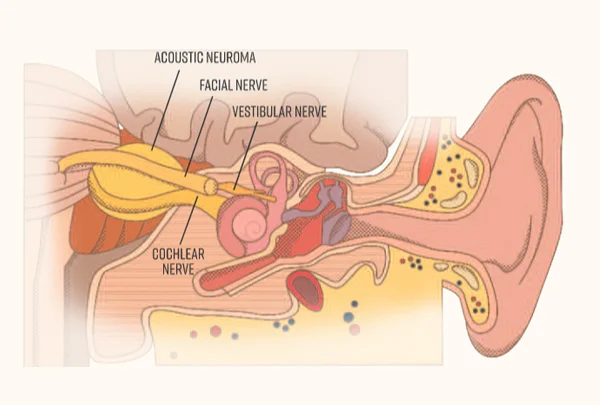 Pregnancy Acoustic Surgery