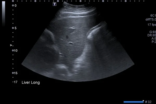 USG Whole Abdomen